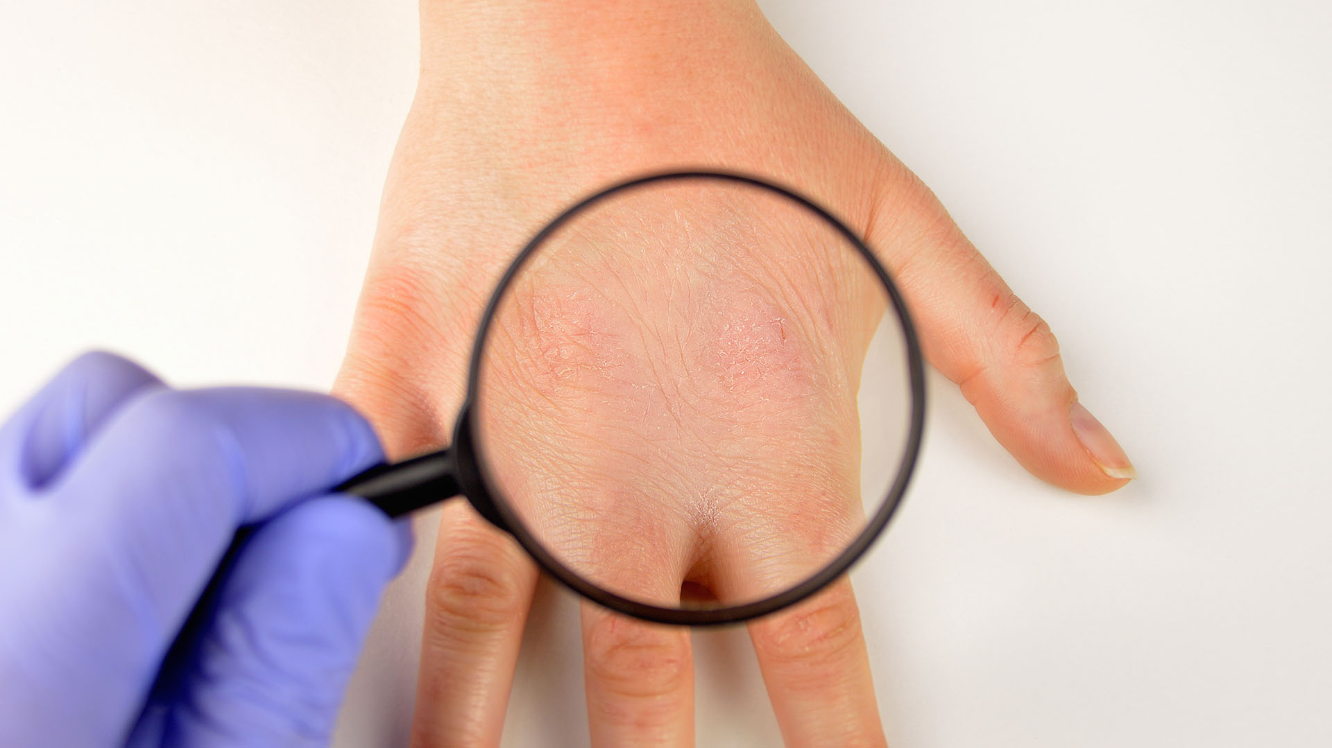 Dermatitis atópica, una afección de la piel que comienza en la niñez y causa molestias durante toda la vida