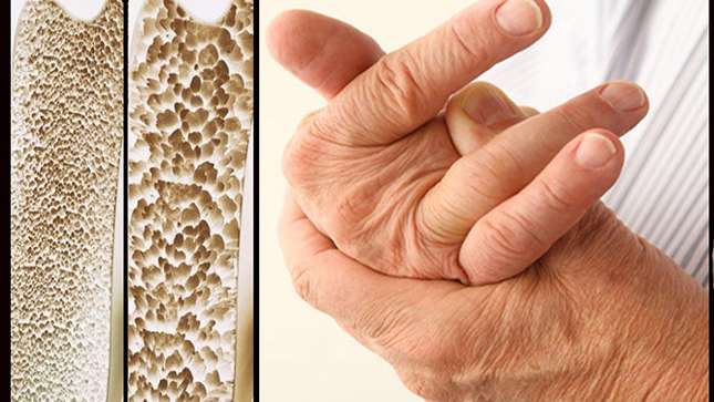 osteoporosis