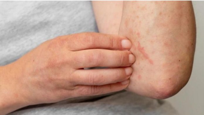 DERMATITIS