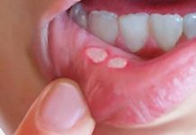 Récord de casos de sífilis en Argentina: especialistas alertan por la baja del uso del preservativo y la desinformación